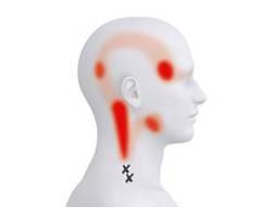 Ein typischer „Joker“-Muskel (M. trapecius pars descendens)